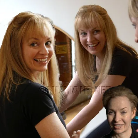 Anna — hair restoration result, Nu Hair of Texas