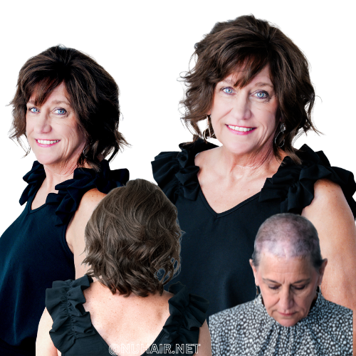 Barbara — hair restoration result, Nu Hair of Texas