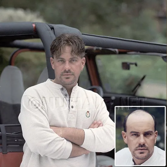 Brian — hair restoration result, Nu Hair of Texas