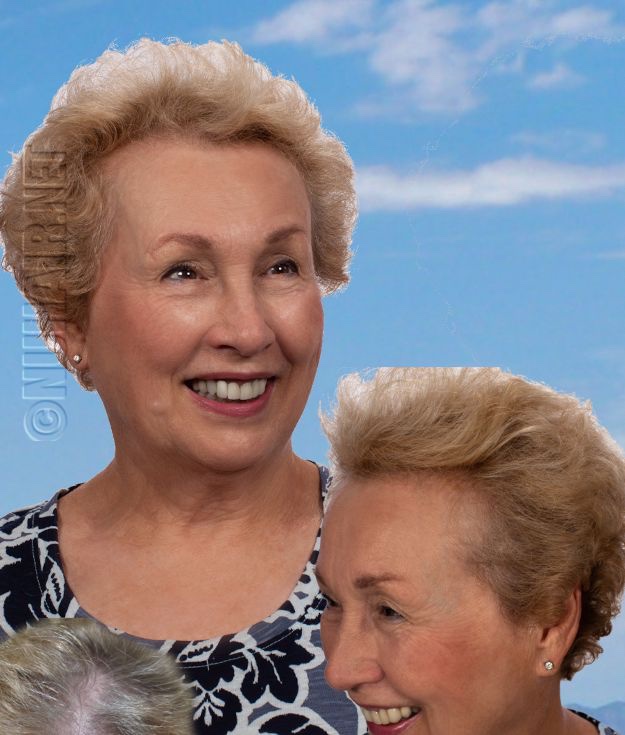 Carol — laser hair therapy result, Nu Hair of Texas