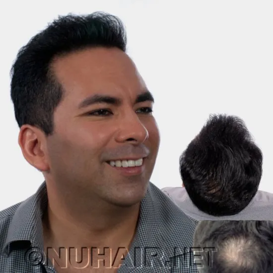 Charles — hair restoration result, Nu Hair of Texas