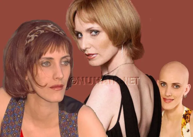 Cynthia — hair restoration result, Nu Hair of Texas