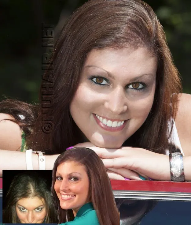 Desiree — hair restoration result, Nu Hair of Texas