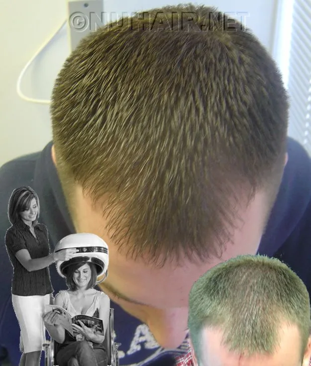 Best Laser Hair Growth Dallas DFW TX