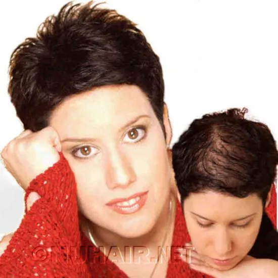 Fanny — hair restoration result, Nu Hair of Texas