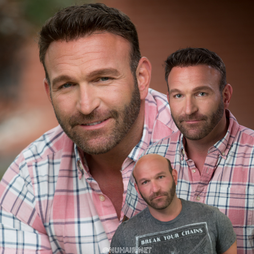 Men Hair Replacement Hair Loss Treatment DFW TX