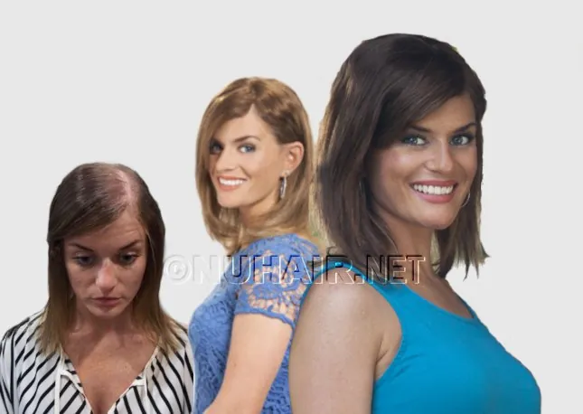 Kim — hair restoration result, Nu Hair of Texas
