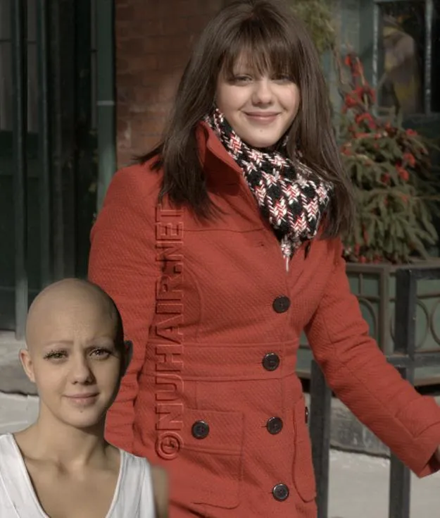Alopecia Thyroid Hair Loss Medical Wigs Dallas TX