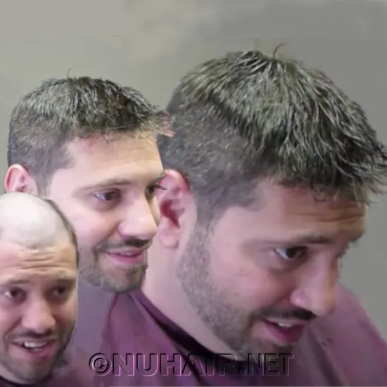 Tino — hair restoration result, Nu Hair of Texas