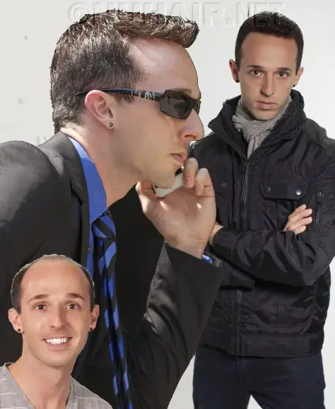 Men's Hair Replacement for Hair Loss, No Hair Transplant Costs or Side Effects Dallas DFW, TX