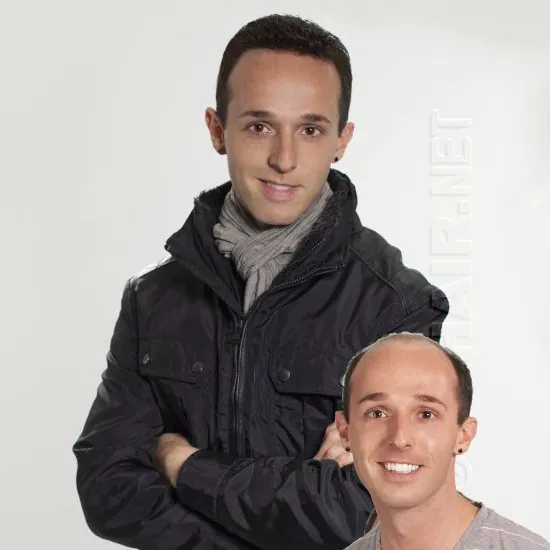 Travis — hair restoration result, Nu Hair of Texas