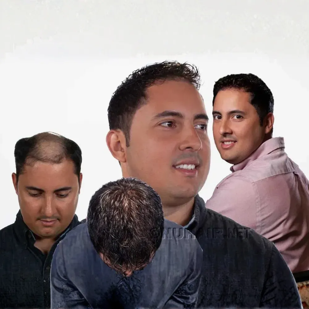 Men's Hair Restoration Nonsurgical Hair Replacement in Dallas, Texas