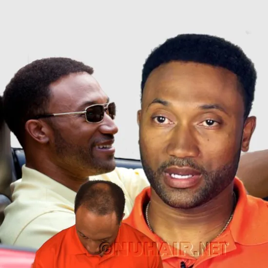 Hair Replacement Systems For Black Men Dallas & DFW, TX