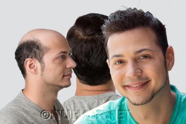 Men's Hair Replacement System Dallas TX