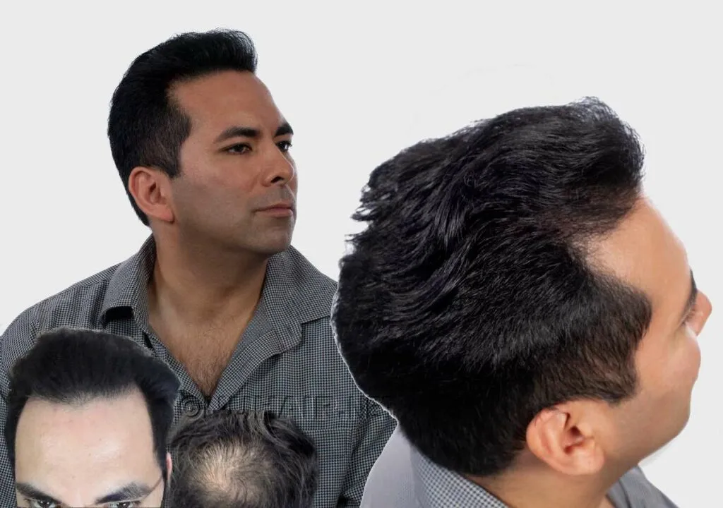 Men's Hair Loss Laser Hair Therapy Treatment Dallas DFW