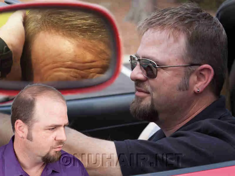 Best Hair Loss Treatments nonsurgical Hair Replacement System Dallas DFW