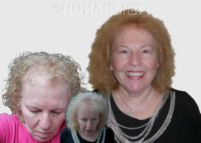 Laser Hair Treatment For Female Hair Loss Dallas DFW TX