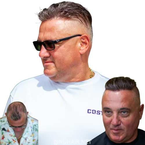 Style Men's Hair System, Men's Hair Restoration Replace Hair Transplants DFW TX
