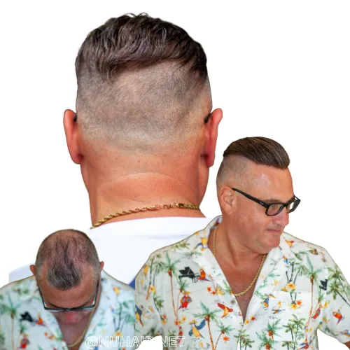 Men's Hair Loss Treatment Replaces Hair Transplant Surgery