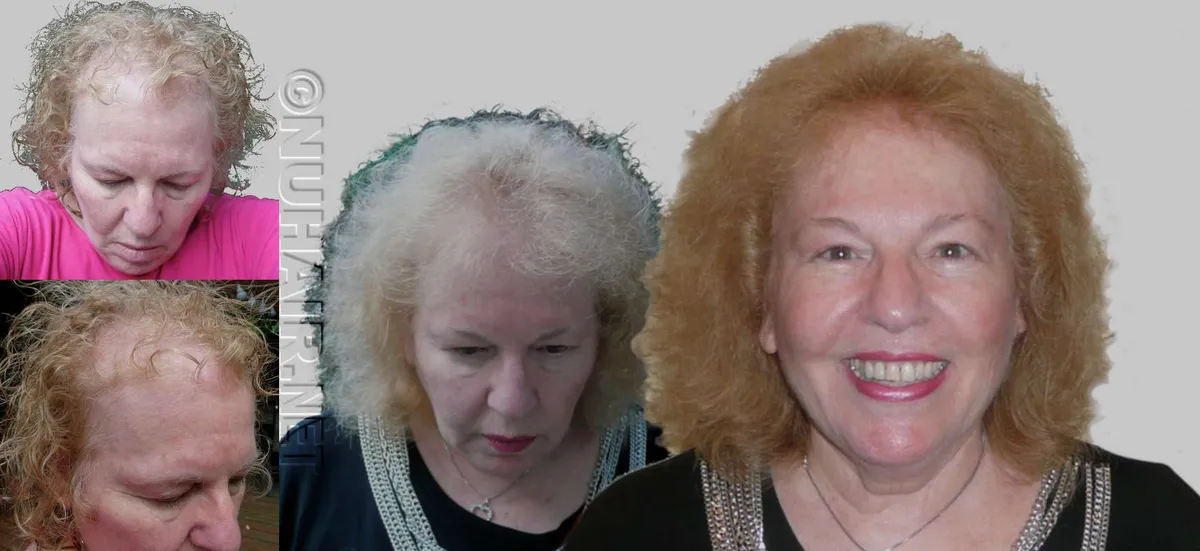 Best Hair Loss Treatment