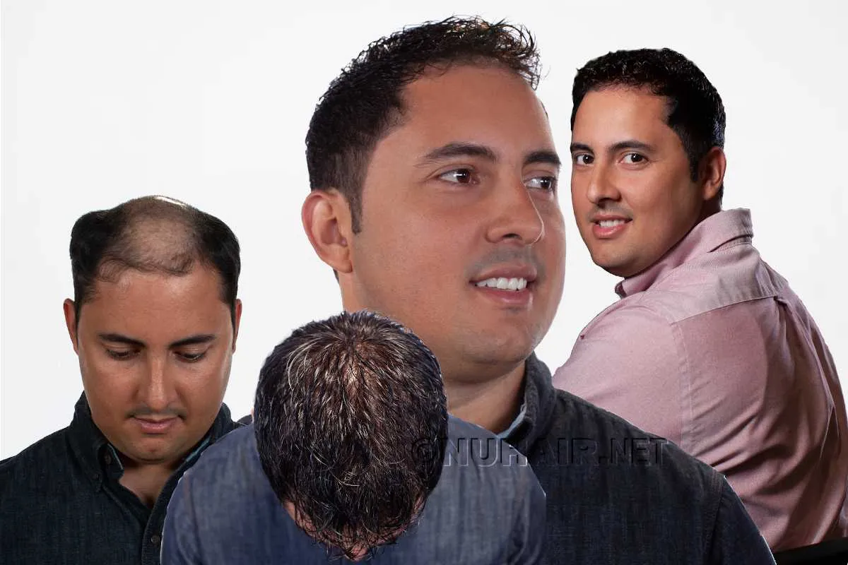 Men's hair Restoration Hair Replacement Systems Dallas DFW