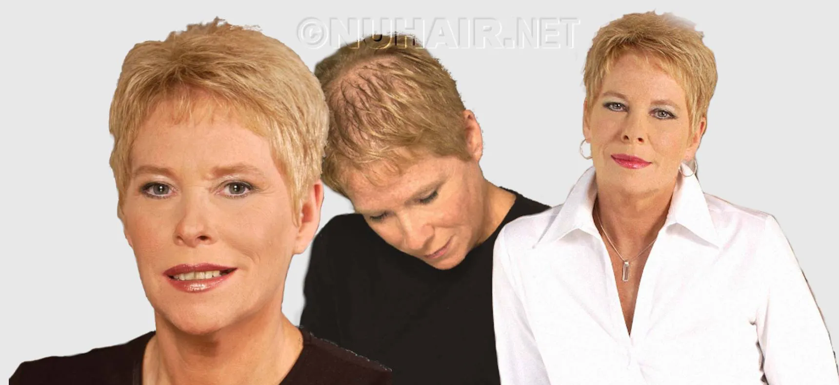 Hair Replacement Female Hair Loss Treatment Dallas