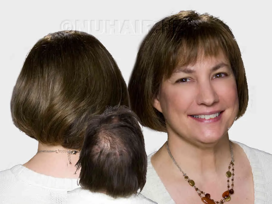 Female Hair Restoration in Dallas DFW TX
