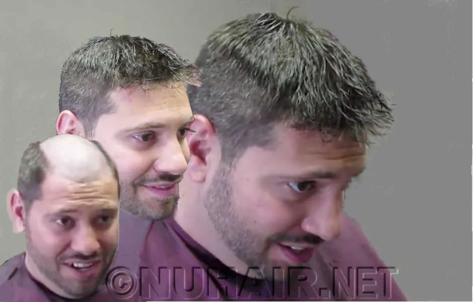 Best Hair Loss Treatment For Men - 4 Top Treatments for Men