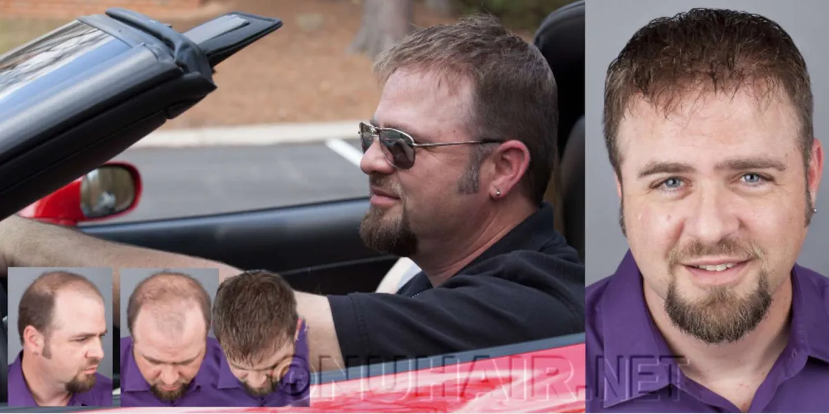 USA Hair Restoration & Hair Transplants Use Rise To New High