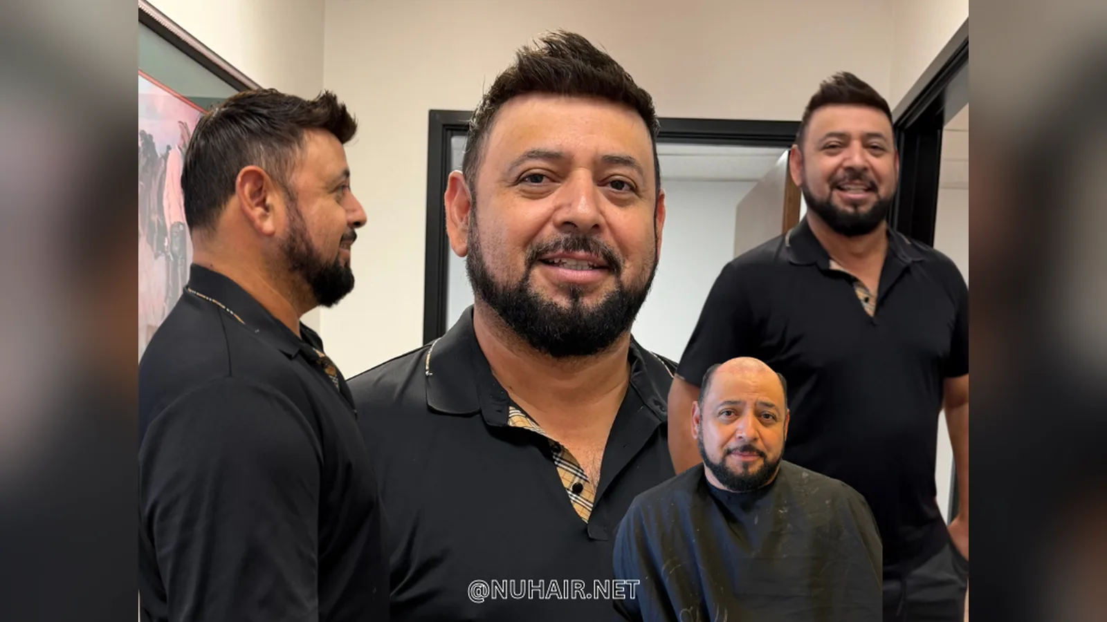 Francisco before and after: no-surgery men's hair restoration, Nu Hair of Texas, Dallas