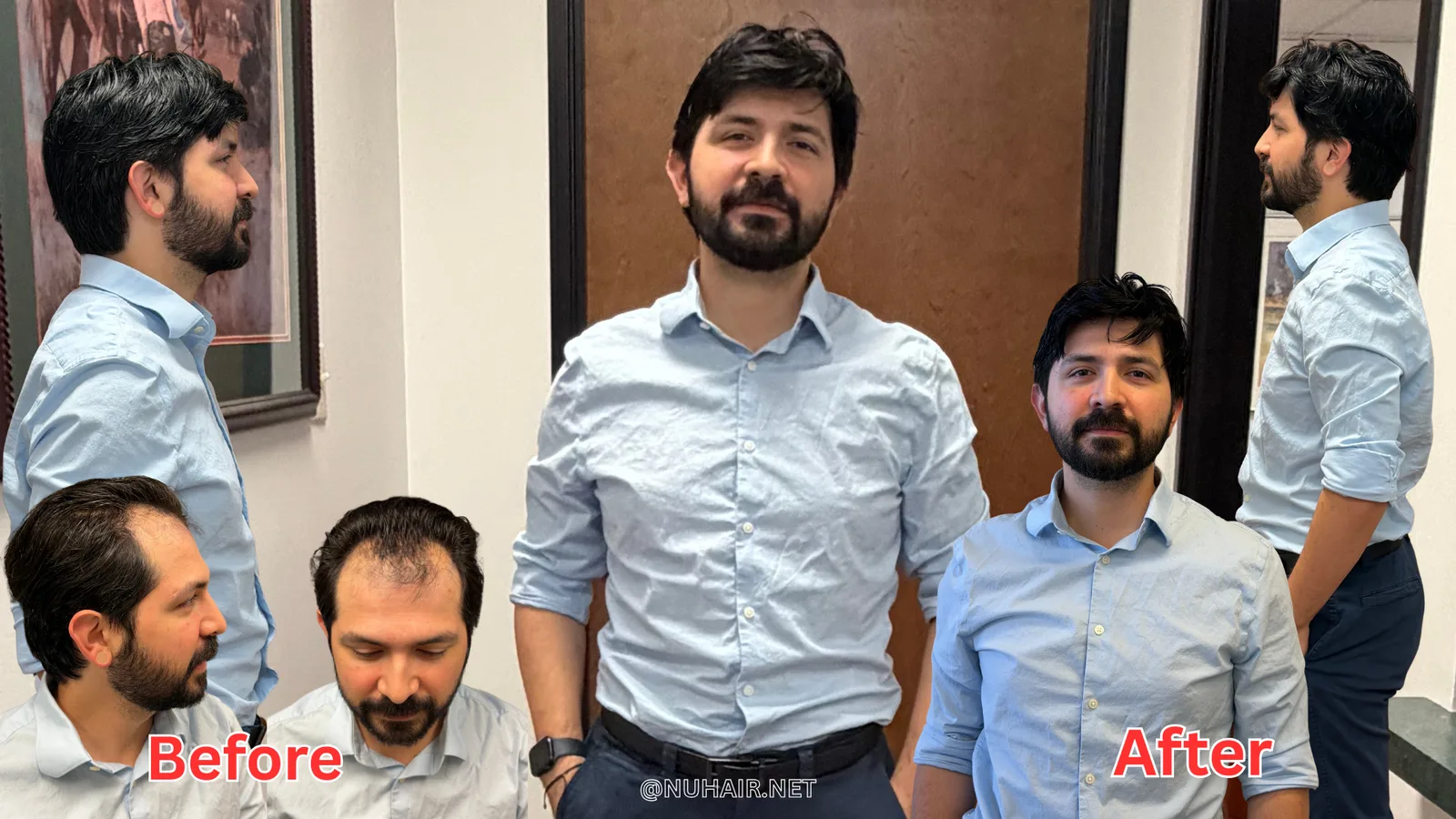Eric D. before and after: men's hair system transformation at Nu Hair of Texas, Dallas