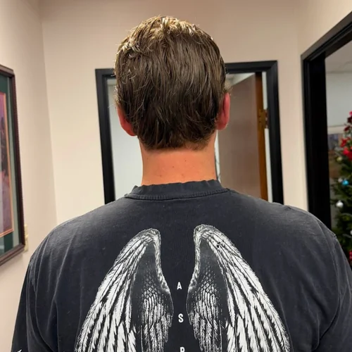 B.T. — men's hair restoration result, Nu Hair of Texas