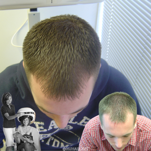 Frank — laser hair growth result, Nu Hair of Texas