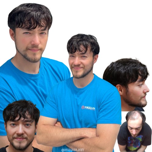 Justice — men's hair restoration result, Nu Hair of Texas