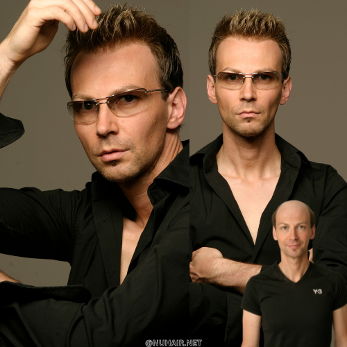 Lucas — hair restoration result, Nu Hair of Texas