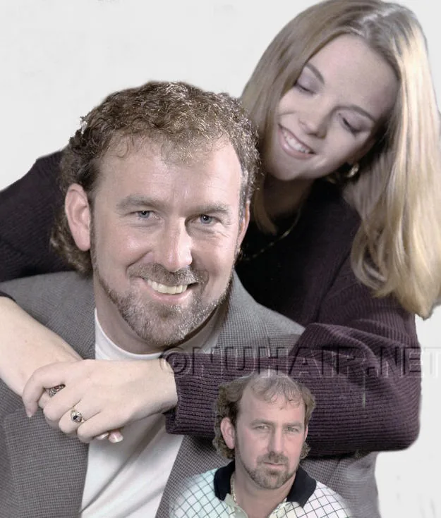 Man Curly Hair Replacement for Hair Loss DFW TX