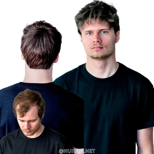 Matt — men's hair restoration result, Nu Hair of Texas