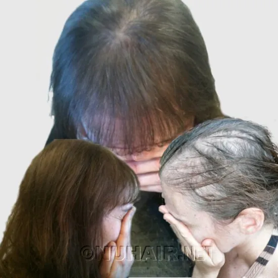 Female Hair Growth Laser Treatment Dallas-DFW, TX