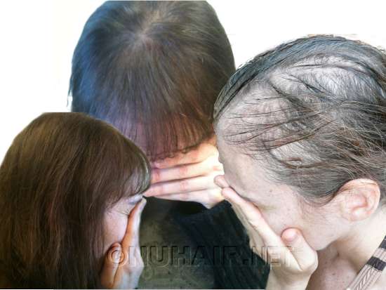 Laser Female Hair Treatment to Stop Hair Loss Dallas TX