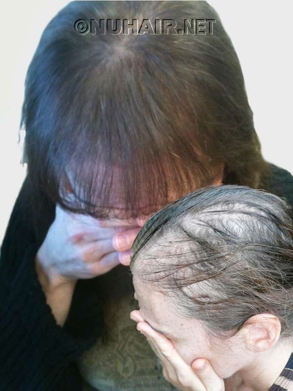 Grow Hair Laser Alopecia Treatment Dallas TX