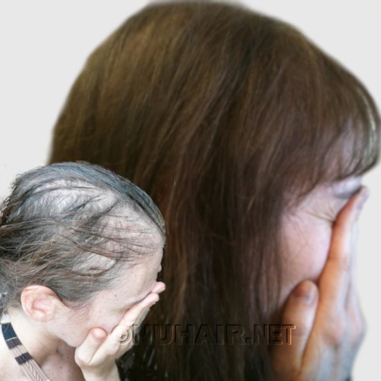 Female Hair Growth Laser Treatment For Hair Loss Dallas, TX