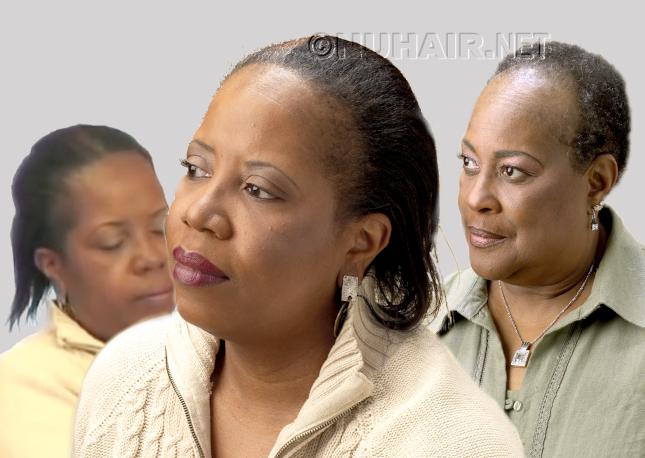 Hair Loss Diagnosis - Balding Black Women with Traction Alopecia