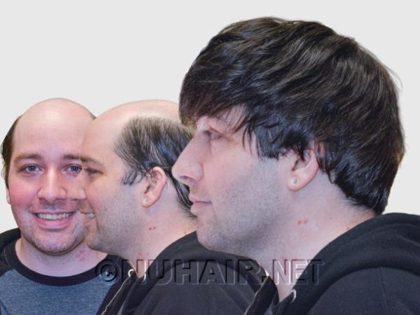 Men’s Hair Loss hair Restoration USA Men's Hair Loss hair Restoration USA