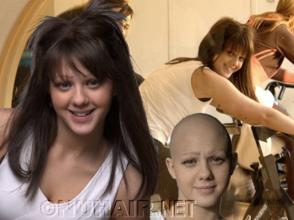Alopecia Areata Hair Loss Medical Wig Dallas, TX